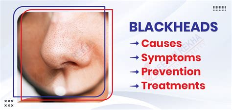 Blackheads: Causes, Symptoms, Prevention, and Treatments