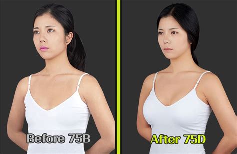 Breast Augmentation Surgery- Premium Teardrop Implant: Dual Chamber