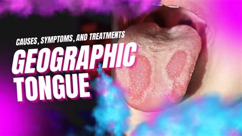 Understanding Geographic Tongue: Causes, Symptoms, and Treatments ...