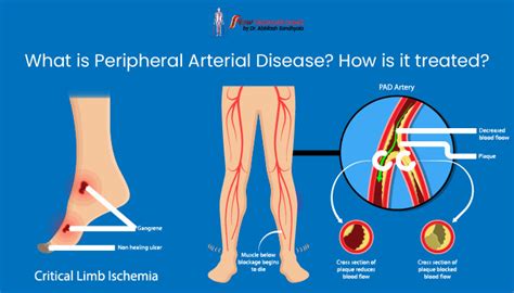 What is Peripheral Arterial Disease? How is it treated? | Dr Abhilash