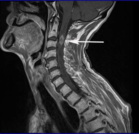 cervical spine mri with contrast Car Tuning