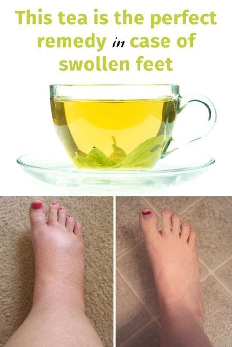 This tea is the perfect remedy in case of swollen feet | Foot remedies ...