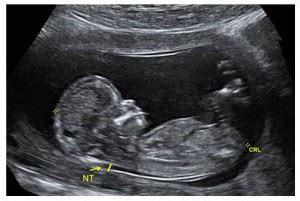 11-14 Week (Nuchal Translucency) Ultrasound - Prenatal Screening Ontario