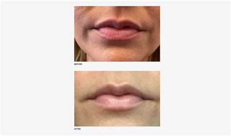 Botox Lip Flip vs. Lip Filler: Pain Level & Results | RealSelf News