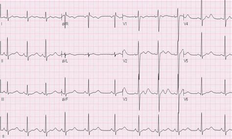 Hypokalemia - Symptoms, Causes, ECG and Treatment