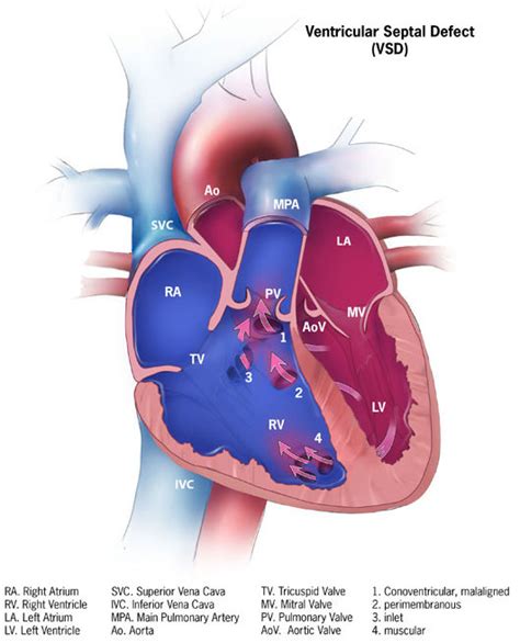 Ventricular septal defect - Wikipedia