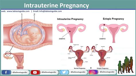 Intrauterine Pregnancy: Understanding Development, Signs, and Care