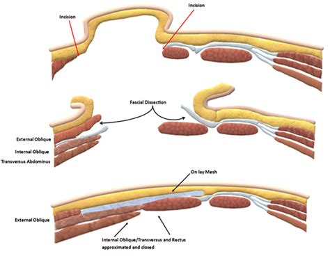 Lateral and Anterior Fascial Release with Onlay Mesh: An Elegant ...