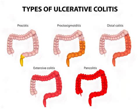 Ulcerative Colitis (UC): Causes, Symptoms, Types, Diagnosis & Treatment ...