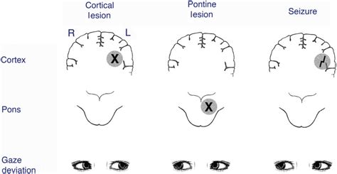 Eye Movement Disorders: Conjugate Gaze Abnormalities | Ento Key