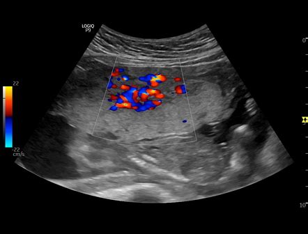 Viewing playlist: Placenta Accreta | Radiopaedia.org