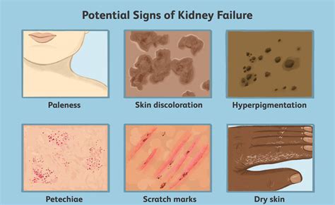 All About Kidney Disease Issue Symptoms-Stages-Treatment-Foods