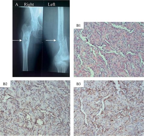 Imaging and pathology. (A) X-ray of the bilateral femurs revealed a ...