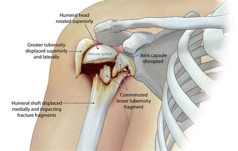 Understanding Comminuted Fractures in Children: Causes, Symptoms, and ...