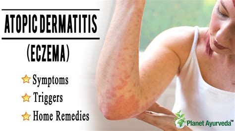 Atopic Dermatitis - Symptoms, Triggers, and Home Remedies