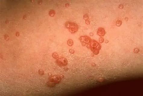 Molluscum Contagiosum: Symptoms, Causes, Treatment and Life Cycle ...