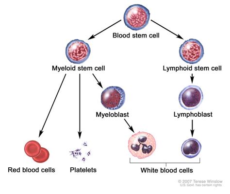 Acute Myeloid Leukemia Treatment - NCI