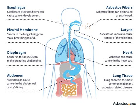 Asbestos Exposure Symptoms