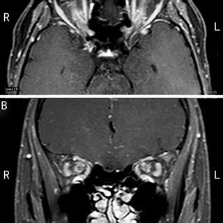 Key differences between optic perineuritis and optic neuritis ...