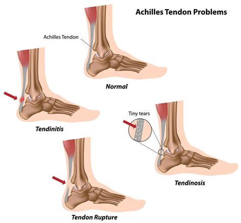 Achilles tendon injuries | healthdirect