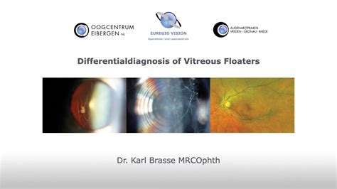 Differentialdiagnosis of Vitreous Floaters - YouTube