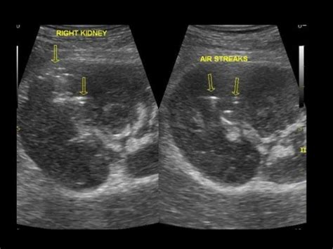 Perinephric abscess | Radiologia