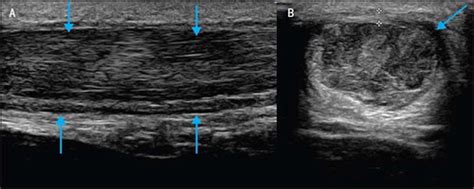 Tendinopathy: Is Imaging Telling Us the Entire Story? | Journal of ...