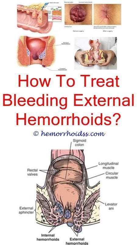 How to heal painful hemorrhoids?.Is preparation h good for bleeding ...