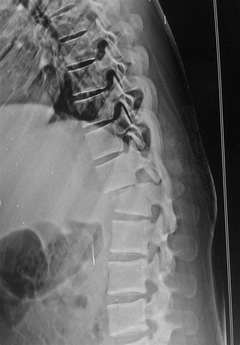 Thoracolumbar Fracture-Dislocation - Spine - Orthobullets