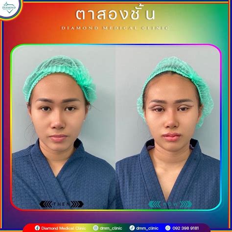 ตาสองชั้น ยกหางหงษ์ 👁 Black Swan Eyes Surgery หรือ ทำตาสองชั้น ยก ...