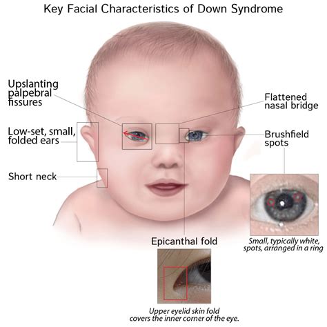 The association of Congenital Heart Defects & Down Syndrome - Blog