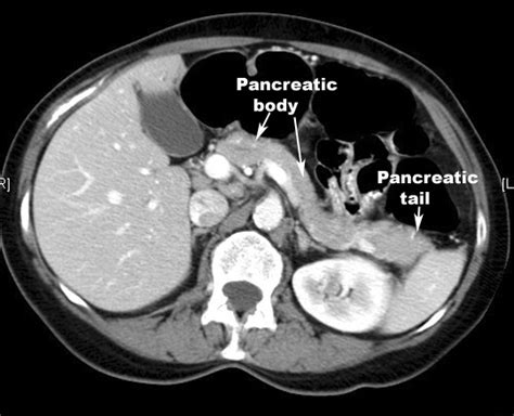 Pancreatitis