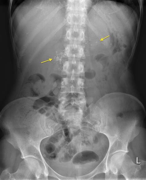 Chronic pancreatitis - Radiology at St. Vincent's University Hospital