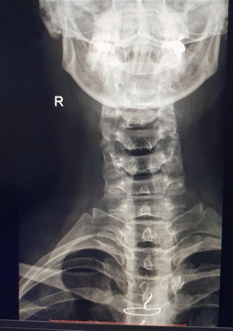 Nothing to see, just some sternal wires : r/Radiology