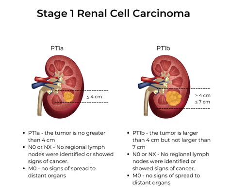 Kidney Cancer Stages | KCCure | kidney cancer | diagnosis | stages