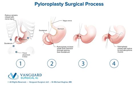 ADVANCED THERAPY FOR GASTROPARESIS: PYLOROPLASTY | Vanguard Surgical ...