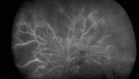 Fluorescein Angiography of Severe Nonproliferative Diabetic Retinopathy ...