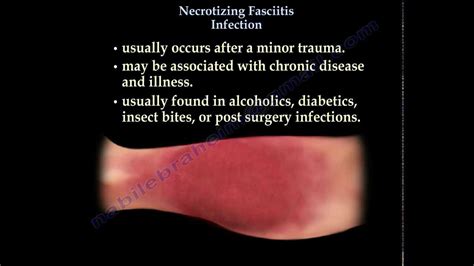 Necrotizing Fasciitis - Everything You Need To Know - Dr. Nabil ...