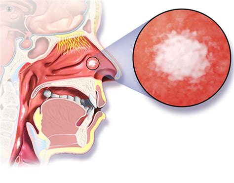 Nasal cancer: what is it, symptoms and treatment | Top Doctors