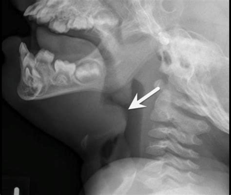 Swollen Epiglottis Treatment