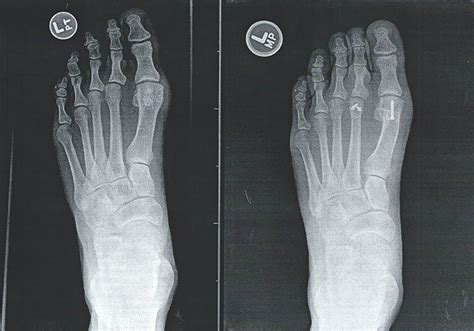 Carriero & Gilles Foot and Ankle|Plantar-Plate-Repair-3