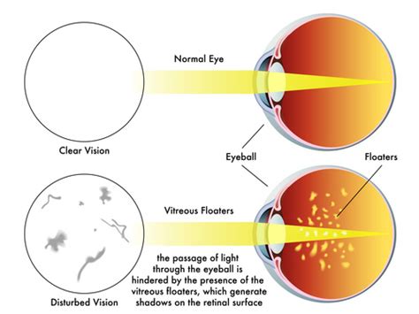 SEEING SPOTS? - Dr. John D. Bissell O.D.