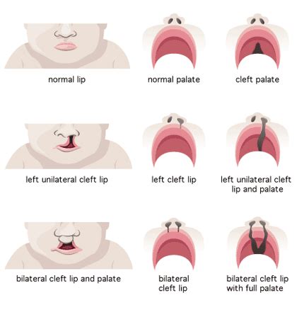 Cleft Lip and Palate - Connecticut Children's Medical Center