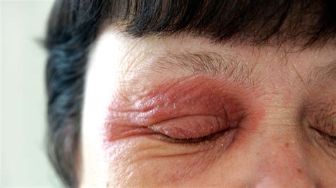 What Causes Rashes On Eyelids | Makeupview.co