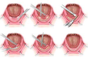 Tori Removal Mexico - CDS Top Dental Clinic in Cancun Mexico