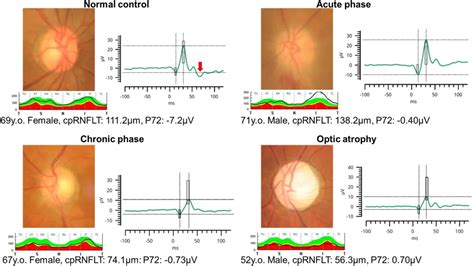 Optic Nerve Disorders Archives - LKC Technologies