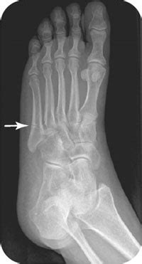 Metatarsal fracture - needqust