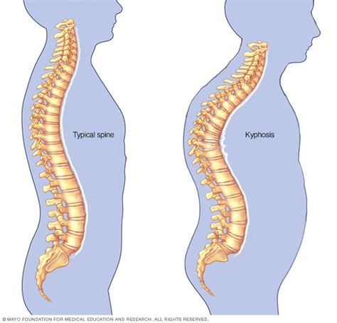 Kyphosis - Symptoms and causes - Mayo Clinic