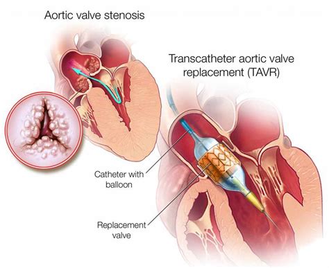 Percutaneous Heart Valve Replacement - The Heart & Vascular Centre