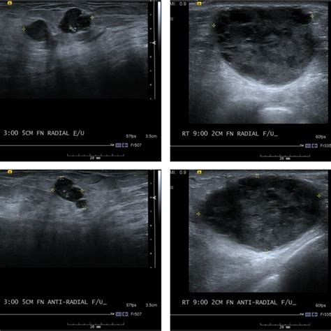 Bilateral diagnostic mammogram at the time of initial evaluation. Top ...